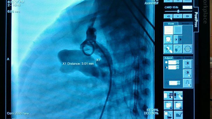 PDA device closure in 13 months old child
