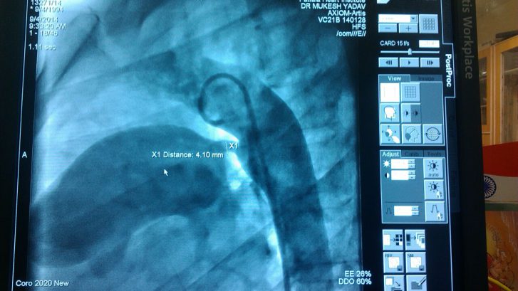 PDA device closure in 13 months old child