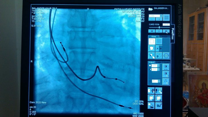 CRT device in 65 years old female (DCMP & Heart Failure)