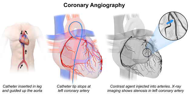 Here’s What You Should Know About Coronary Angiography
