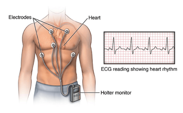 When and Why You Need a Holter Checkup