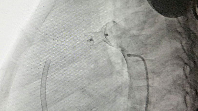 Successful PDA device closure in 5 year old child